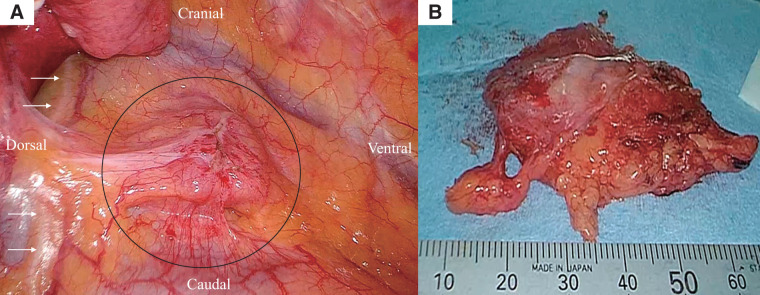 Thymoma without Myasthenia Gravis Showing Size Fluctuation in Parallel to Alopecia Areata Activity: A Case Report.