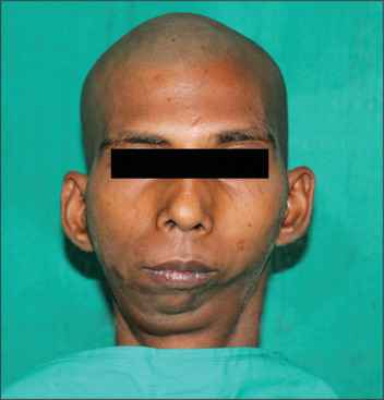 Patient-Specific surgical management of a triad of TMJ ankylosis, micrognathia, and obstructive sleep apnea: A case report.