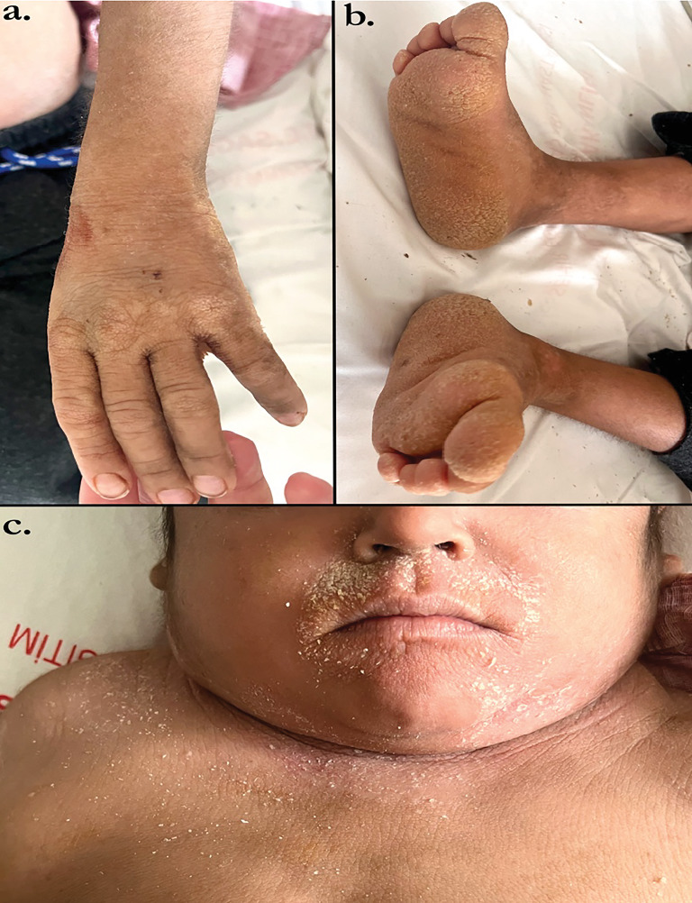 Coexistence of T-Cell Lymphoblastic Lymphoma and Ichthyosis Vulgaris: A Case Report.