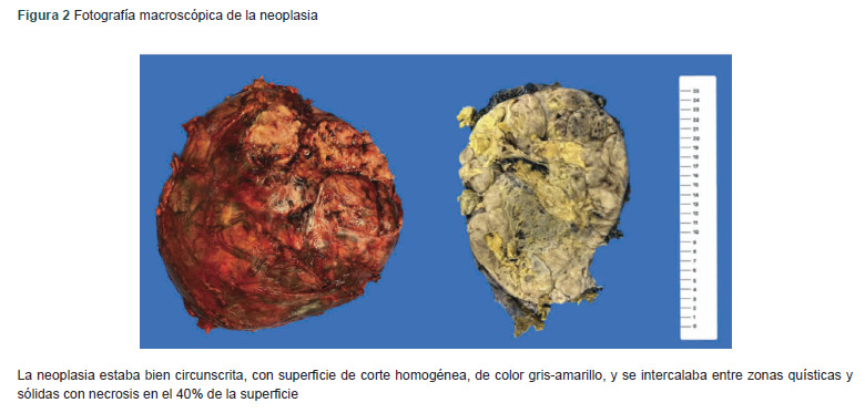 [Doege-Potter syndrome and intra-abdominal giant solitary fibrous tumor: Case report].