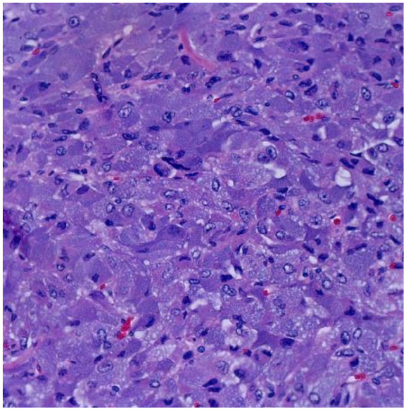 Atypical Presentation of Giant Pheochromocytoma Managed With Minimally Invasive Surgery.