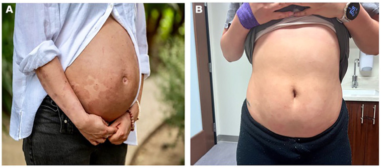 An Unusual Presentation of Bullous Skin Lesions During Pregnancy.