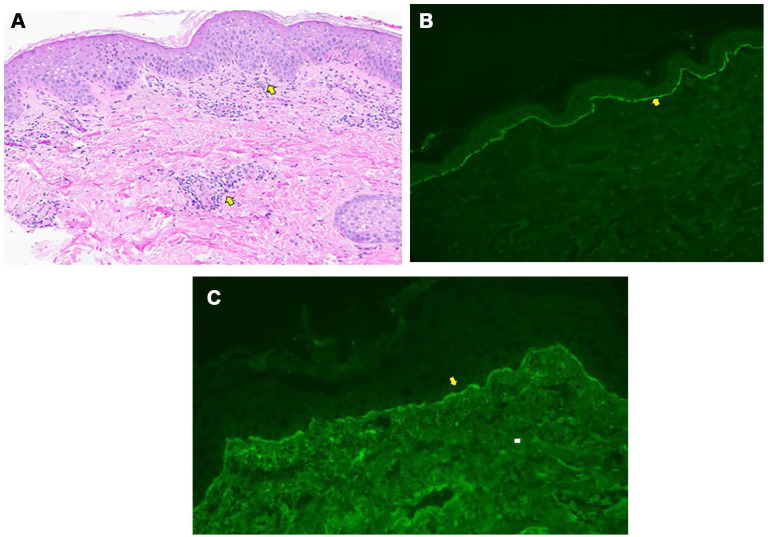 An Unusual Presentation of Bullous Skin Lesions During Pregnancy.