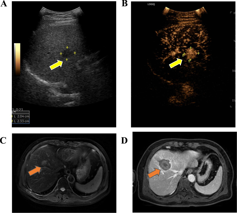 Decision-Making for Ablation of Colorectal Liver Oligometastases Patients: A 10-Year Retrospective Study of Survival Outcomes Based on Right-Versus Left-Sided Primary Tumor Location.