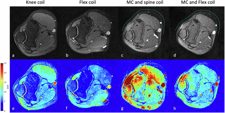Flexible and wireless metasurface coils for knee and elbow MRI.