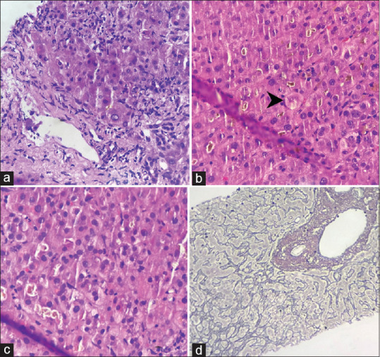 Occupational Liver Disease: An Underestimated Entity of Liver Injury.