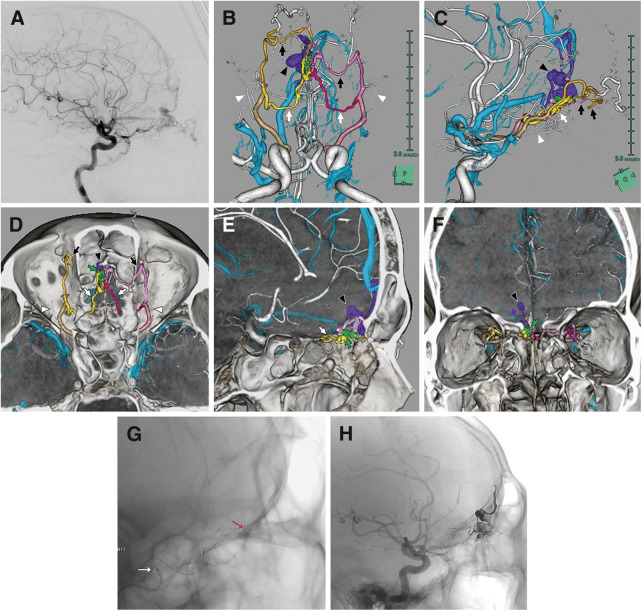 Endovascular Treatment of Anterior Cranial Fossa Dural Arteriovenous Fistula.