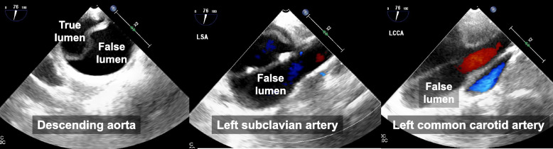 Acute aortic dissection during minimally invasive cardiac surgery: a case report.
