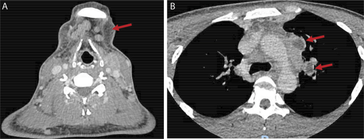 Disseminated nontuberculous mycobacterial infection in the context of interferon-gamma autoantibody syndrome: A case report and review of the literature.