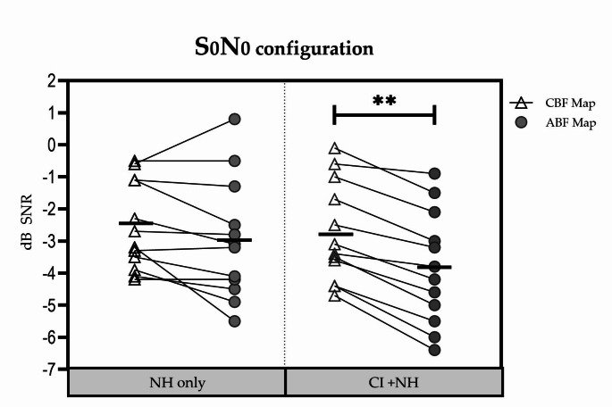 Anatomy-based fitting improves speech perception in noise for cochlear implant recipients with single-sided deafness.