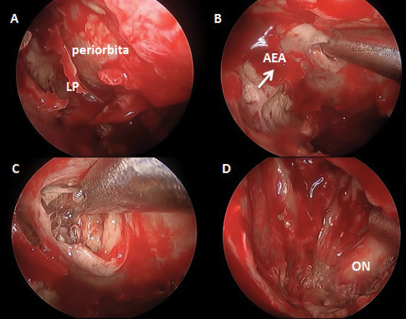 Endoscopic Orbital Clearance/Debridement: A Potential Substitute for Orbital Exenteration in Rhino-orbital Mucormycosis.