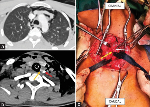 Esophageal Injury Following Blunt Trauma: A Diagnostic Dilemma.