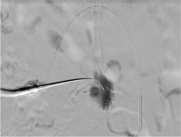 Novel pain management strategy for uterine fibroid embolization.