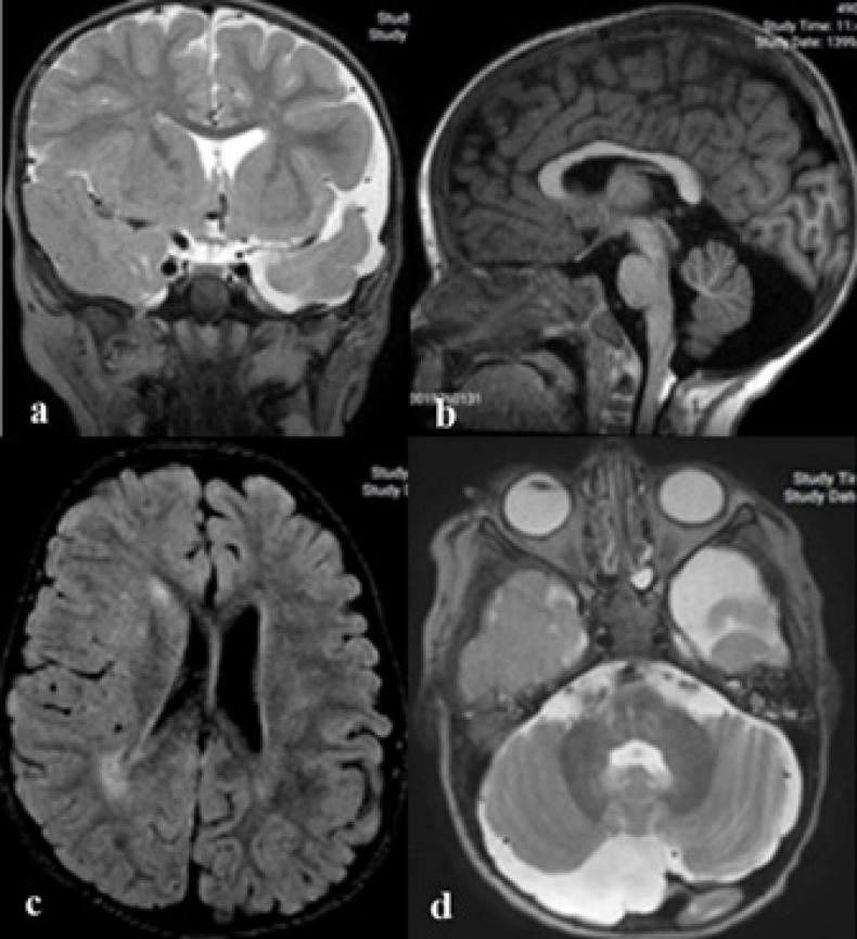 Haberland Syndrome (Encephalocraniocutaneous Lipomatosis): A Case Report and Review of Literature.