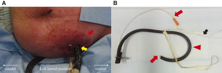 Esophageal Atresia Caused by Corrosive Esophagitis for over 50 Years: A Case Report.