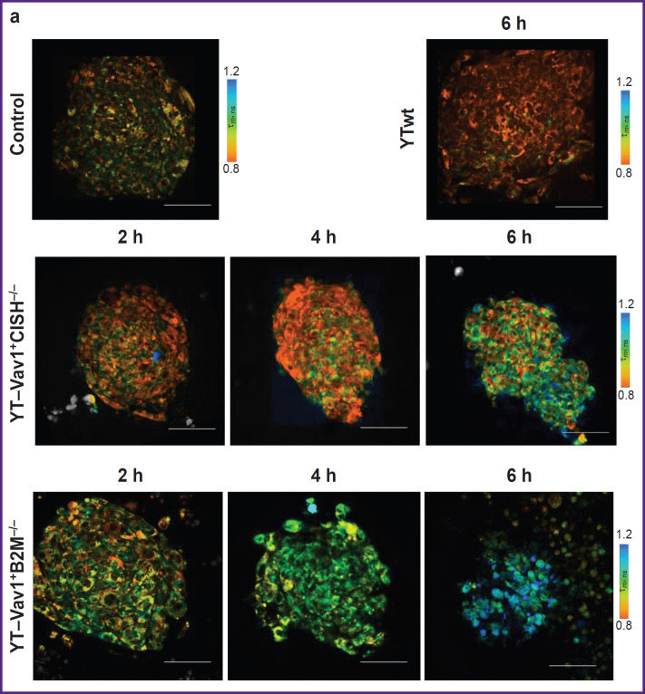 Efficacy Evaluation of "Enhanced" Natural Killers with <i>CISH</i> and <i>B2M</i> Knockouts on Viability and Metabolic Status of 3D Glioblastoma Spheroid Cells in Patients.