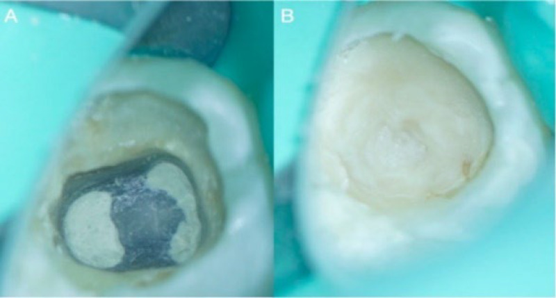 The Impact of Vital Pulp Therapy on Normal Root Development in Immature Teeth: A Case Report.