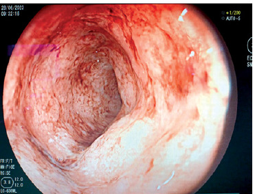 New challenges in the management of inflammatory bowel disease: a case study.