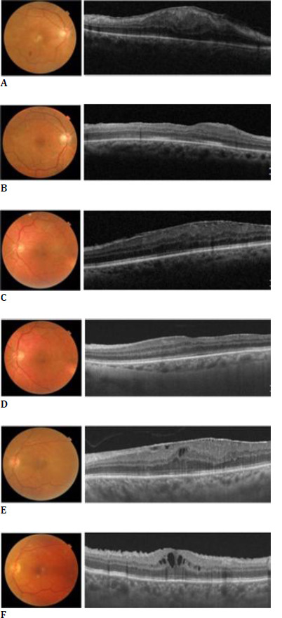 Surgery for epiretinal membrane using three different surgical platforms: A comparative pilot study.