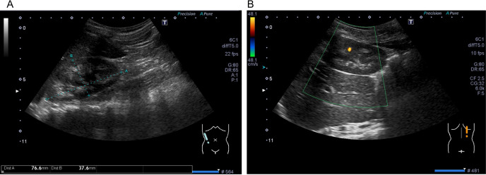 Idiopathic infantile hypercalcemia with a <i>CYP24A1</i> variant triggered by vitamin D supplementation in fortified milk: A case report.