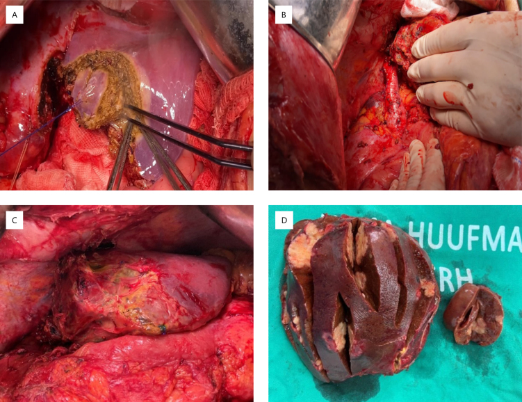 SURGICAL TECHNIQUES TO INCREASE RESECTABILITY IN LIVER METASTASIS.