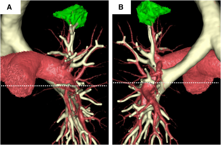 Robotic Segmentectomy in a Patient with a Displaced Left Upper Division Bronchus and Fused Fissure.