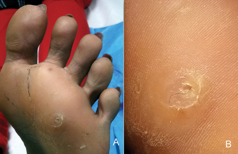 The Curious Case of a Pilonidal Sinus of the Sole of the Foot Mimicking a Painful Corn: An Unusual Entity.