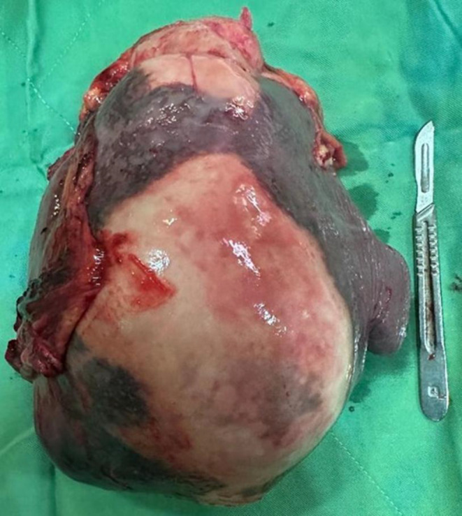 Peritoneal Hydatid Cyst Mimicking Peritoneal Seeding; A Case Report.