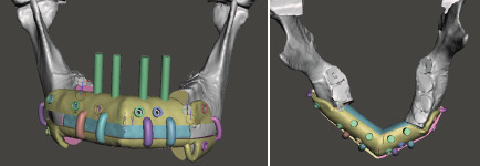 Fully Digital Workflow for Immediate Prosthetic Implant on Microsurgery Fibula Flap for Mandibular Reconstruction.