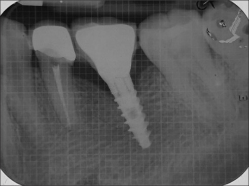 Survival of narrow diameter implants in supporting single crowns in the molar region of the jaw.