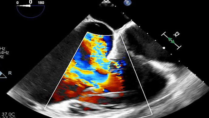 Potential Use of Systolic Pulmonary Artery Pressure/Pulmonary Artery Acceleration Time Ratio in Severe Functional Tricuspid Regurgitation with Pulmonary Hypertension.