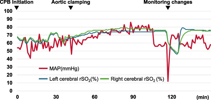 Acute aortic dissection during minimally invasive cardiac surgery: a case report.