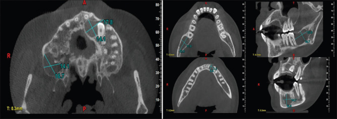 Navigating Beyond a Cyst: The Intricate World of Gorlin Goltz Syndrome - A Case Report.