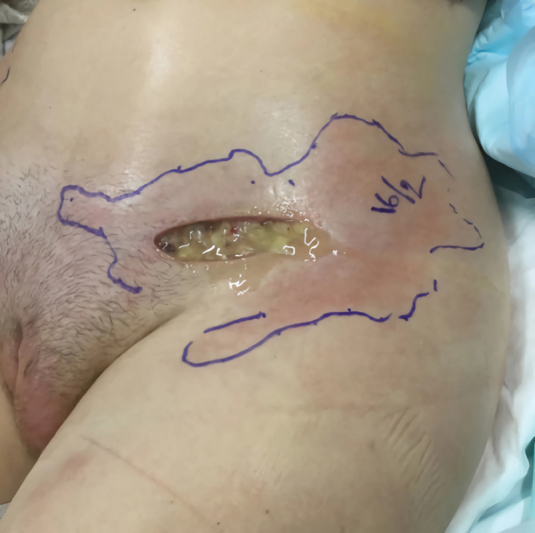 Aquafilling Filler for Buttock Augmentation Cause Severe Long-Term Complications: A Case Report.