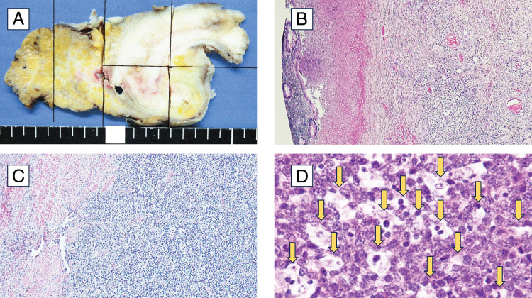 A Case of Appendicitis Due to Burkitt Lymphoma Masking the Systemic Symptoms of Rapidly Progressing Burkitt Lymphoma.