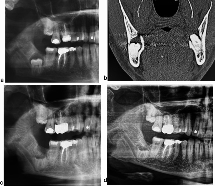 Coronectomy of mandibular third molars with dental pathology: a prospective cohort study of 121 molars.