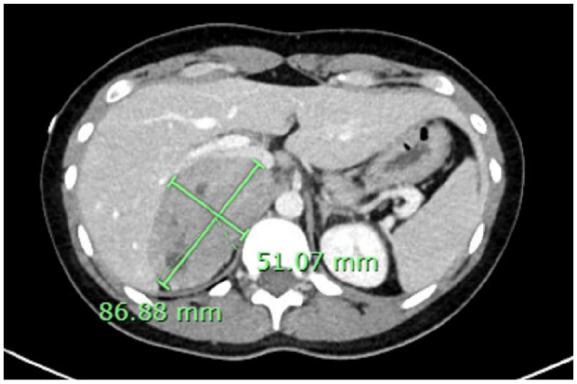 Atypical Presentation of Giant Pheochromocytoma Managed With Minimally Invasive Surgery.