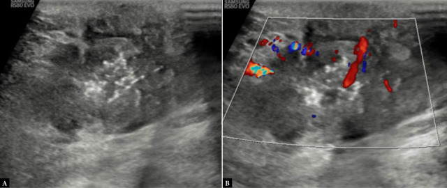 Ultrasonography: an aid in molecular subtyping of breast carcinoma.