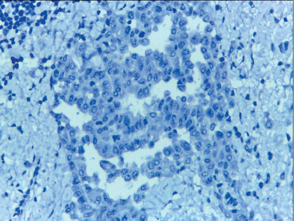 Role of HEG1 and Claudin-4 Immunohistochemistry in the Differential Diagnosis of Lung Adenocarcinoma from Malignant Mesothelioma in Pleural Effusion Cytology.