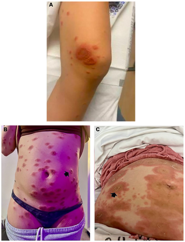 An Unusual Presentation of Bullous Skin Lesions During Pregnancy.