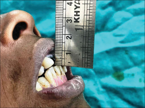 Patient-Specific surgical management of a triad of TMJ ankylosis, micrognathia, and obstructive sleep apnea: A case report.