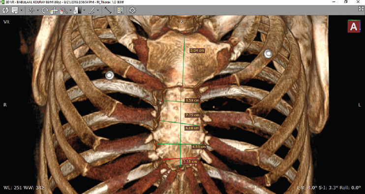 Determination of Sex from Morphometry of Sternum Using Multidetector Computed Tomography in Central Indian Population.