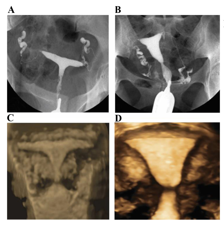 Comparison of <i>In Vitro</i> Fertilization Outcomes between Normal and T-Shaped Uteri, Diagnosed by Hysterosalpingography in Women with infertility: A Retrospective Cohort Study.