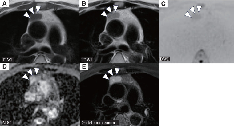Thymoma without Myasthenia Gravis Showing Size Fluctuation in Parallel to Alopecia Areata Activity: A Case Report.