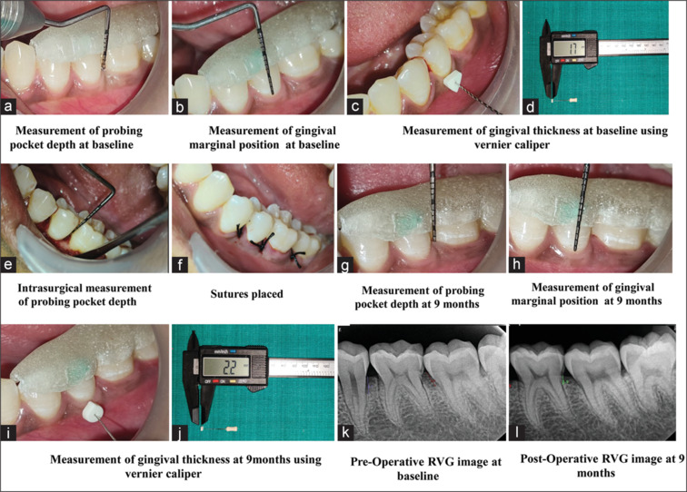 Evaluation of autologous periodontal stem cells niche in the treatment of periodontal intrabony defects: A split-mouth randomized controlled trial.