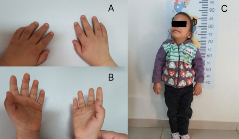 Jacobsen syndrome associated with Shone's complex: a case report.