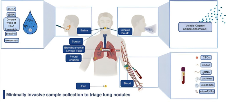 Minimally invasive biomarkers for triaging lung nodules-challenges and future perspectives.