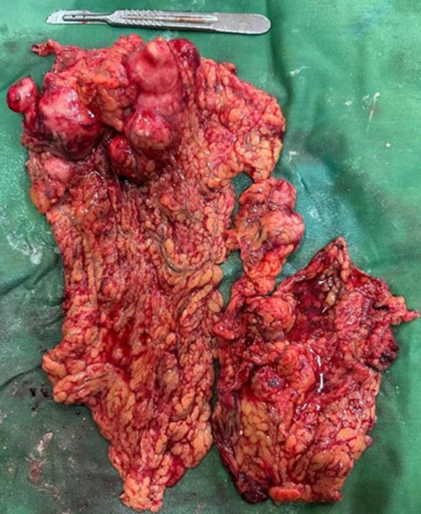 Peritoneal Hydatid Cyst Mimicking Peritoneal Seeding; A Case Report.