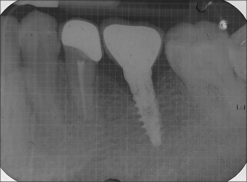 Survival of narrow diameter implants in supporting single crowns in the molar region of the jaw.