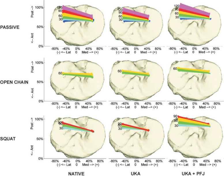 Current status of bicompartmental arthroplasty.